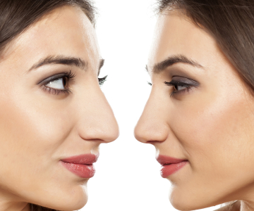 Nicht-chirurgische Nasenkorrektur