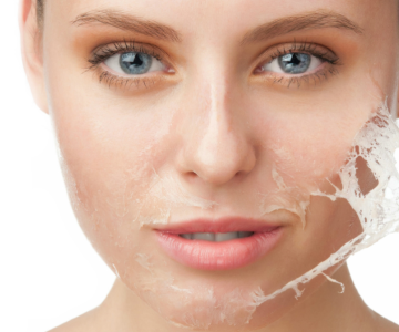 Chemisches Peeling
