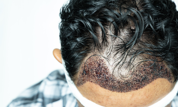 Aydın Haartransplantationszentrum